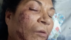 Info Martí | Madre de preso político se recupera de asalto y golpiza en la vía pública Info Martí | Madre de preso político se recupera de asalto y golpiza en la vía pública