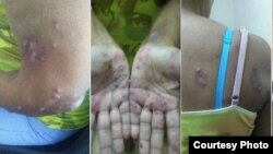 Fotos enviadas desde prisión muestran la afección en la piel de la presa política Xiomara de las Mercedes Cruz Miranda.